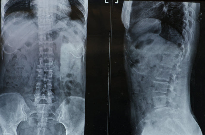 What Can Cause Lower Back Pain?